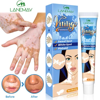 Vitiligo Koor Higi Kohapeal Vitiligo Spot Naha Aktuaalne Koor Kohapeal Care Repair Cream